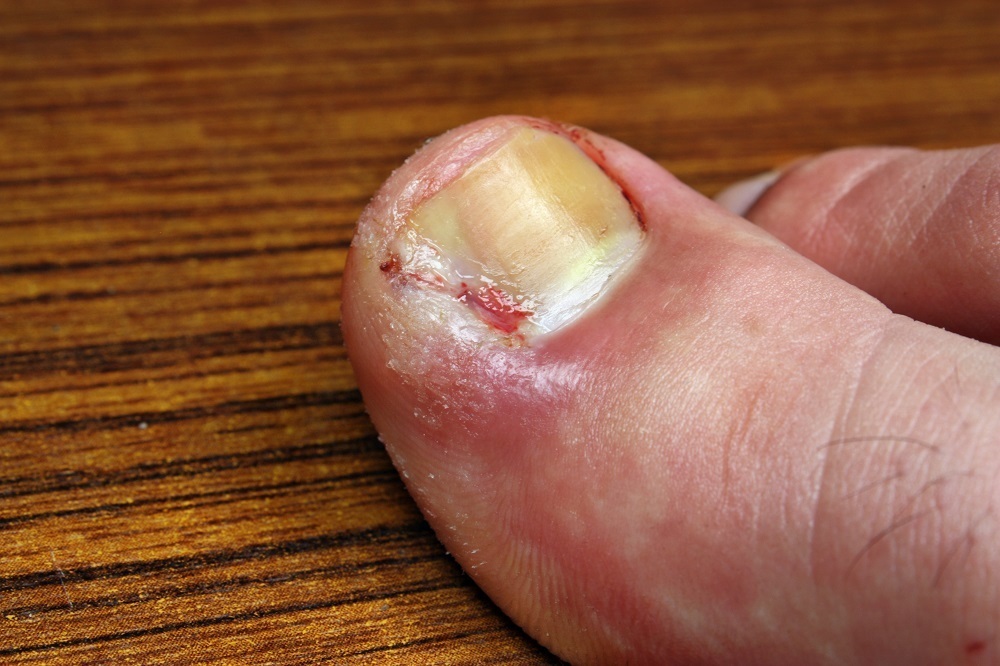 Ingrown toenail Treatment Albany Auckland